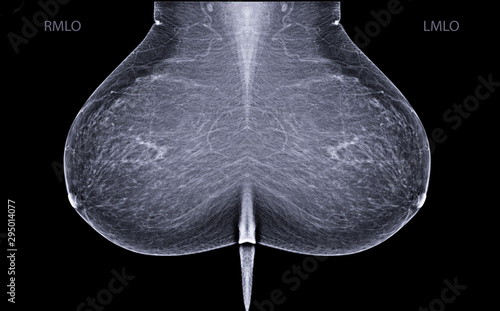 X-ray Digital Mammogram or mammography is x-ray image of the breast in women for screening Breast cancer.