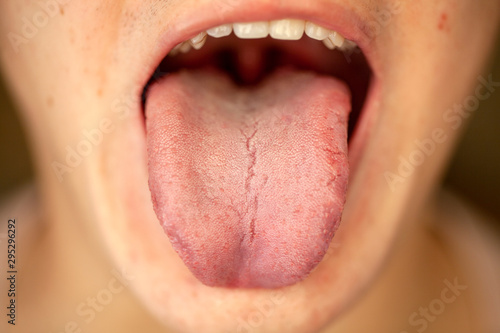 protruding white plaque on tongue, closeup
