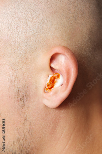 Close up view of a young man with bloody cotton wool in his ear. Concept of ear infections, bleeding and ear pain