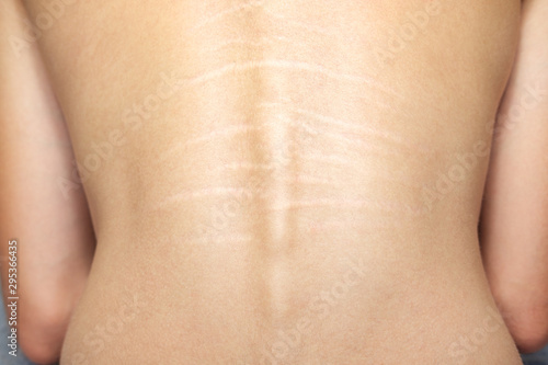 Close up view of the back with .stretch marks on the skin. The concept of impaired skin elasticity during puberty