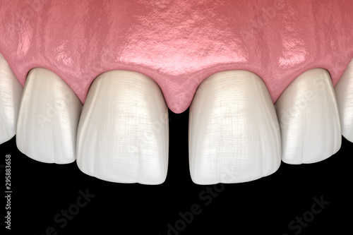 Diastema of central incisors teeth. Dental disfunction 3D illustration concept