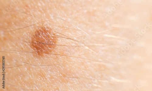 Small mole nevus on human skin, carcinoma. Background, macro