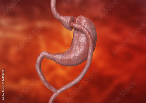 Gastric bypass is a type of bariatric surgery that consists of reducing the stomach and altering the bowel, leading to a marked loss of body weight