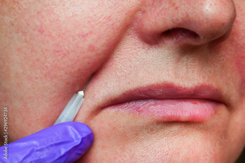 cosmetic injections under the skin of a woman's face, anti-aging procedure, Nasal Labial Folds