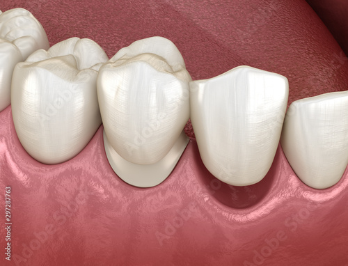 Maryland bridge made from ceramic, frontal tooth recovery. Medically accurate 3D animation of dental concept