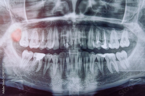 Panoramic x-ray scanning of human teeth. Female teeth with one wisdom tooth highlighted in red