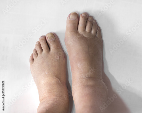 swollen legs with fungal infection isolated on white background