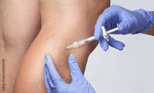 A doctor does medical procedure Sclerotherapy used to eliminate varicose veins and spider veins. An injection of a solution directly into the vein.