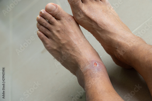 Foot ulcers caused by disease.