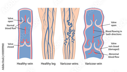 Varicose veins. Image of healthy and diseased legs. A longitudinal section of a vein with a description of the main parts. Vector illustration in flat style