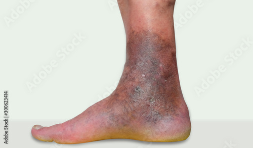 varicose veins leg ulcers