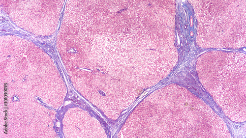 Photomicrograph of liver biopsy in a patient with cirrhosis, showing bridging septal fibrosis and regenerative nodules. Stained with trichrome to highlight fibrosis (blue).