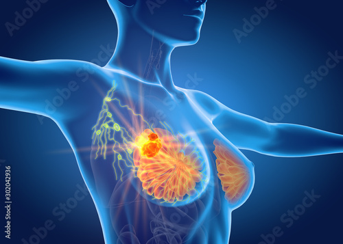 Breast cancer with lymphatics, medically 3D illustration