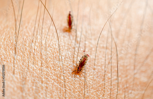 Louse, Head lice feed on blood on human skin.