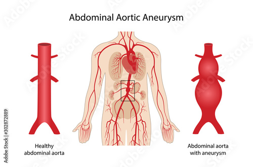 Abdominal aortic aneurysm. Arterial circulatory system of the abdominal. Healthy abdominal aorta and abdominal aorta with aneurysm. Vector illustration in flat style isolated on white background