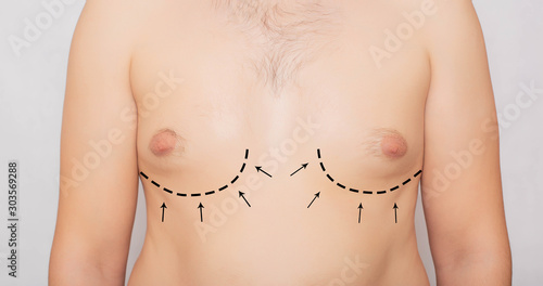 Male body, male breast plastic, gynecomastia. Male Breast Adjustment, Plastic Surgery, Background, medical