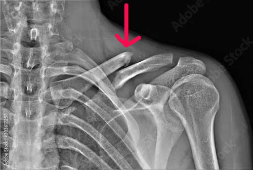 radiography of the shoulder joint and ribs in direct projection with a fracture of the clavicle with displacement, Traumatology and orthopedics