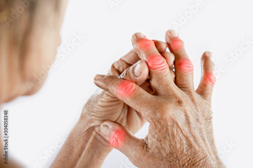 Asian woman hand suffering from joint pain with gout in finger