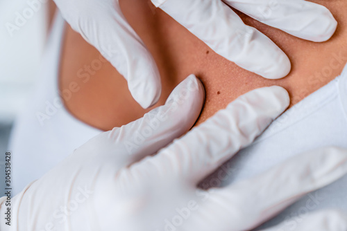 Close up of doctor dermatologist examines birthmark of patient