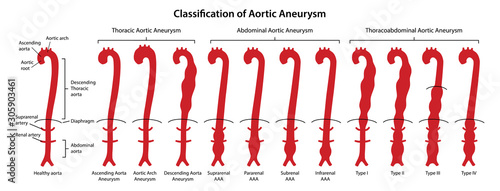 Classification of Aortic Aneurysms. Healthy aorta with main parts labeled and aorta with various types of aneurysm. Vector illustration in flat style isolated on white background