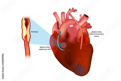 Coronary artery bypass surgery (Bypass using internal mammary artery and Bypass using saphenous vein)