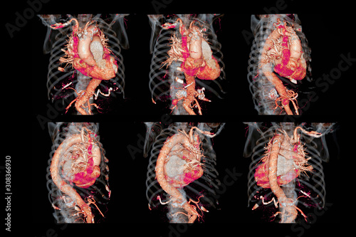 Collection of CTA thoracic aorta 3D rendering image for diagnotic abdominal aortic aneurysm or AAA and aortic dissection