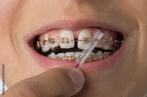 Close up of cleaning dental braces