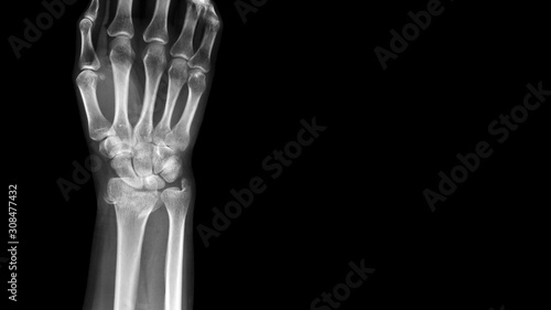 Film X ray wrist radiograph show distal forearm bone broken ( distal end radius fracture). The patient has wrist pain, swelling and deformity. Medical imaging for investigation and technology concept