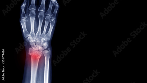 Film X-ray wrist radiograph show lower end of forearm bone broken (distal end radius fracture) from traffic accident. Highlight on broken site and painful area. Medical imaging and technology concept