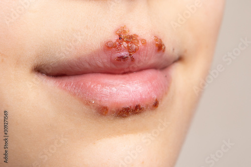 Baby lips with a large herpes simplex infection