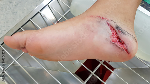 accident wound on foot patient, sterile technique, infection control and dressing process