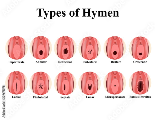 Types of hymen. Imperforate, annular, Denticular, Cribriform, dentate, Crescentic, Labial, Fimbriated, Septate, lunar, Microperforate. Hymen after defloration. Infographics. Vector illustration.