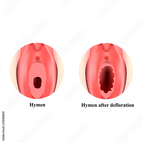 The structure of the vulva hymen. Hymenoplasty. Hymen after defloration. Female genital organs. Infographics. Vector illustration on isolated background.