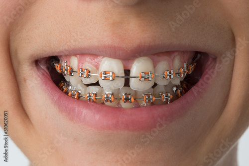 Close up of a mouth with dental braces