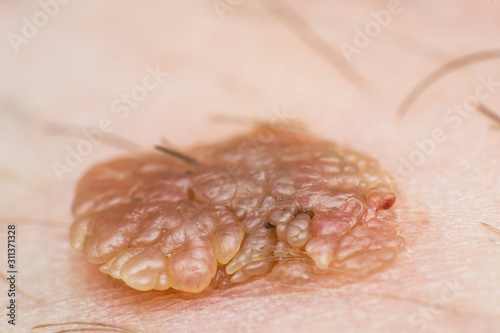 Macro photo of a skin wart, papilloma virus infection