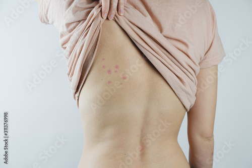 Damaged skin on female's back. Bedbug bites, moosquito bites or skin disease on human body