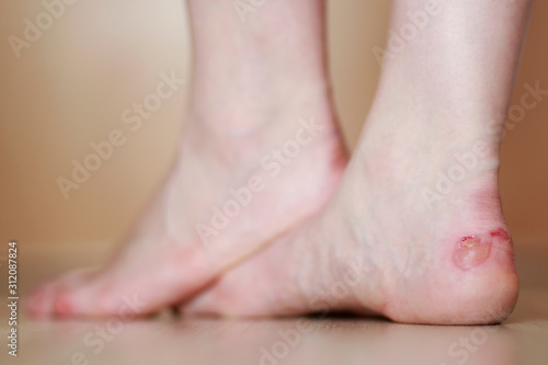 Woman's feet with blister close up. Injured foot from high heels. 