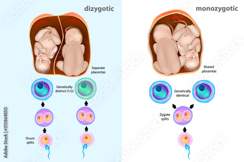 Monozygotic or dizygotic twins. Types of twins