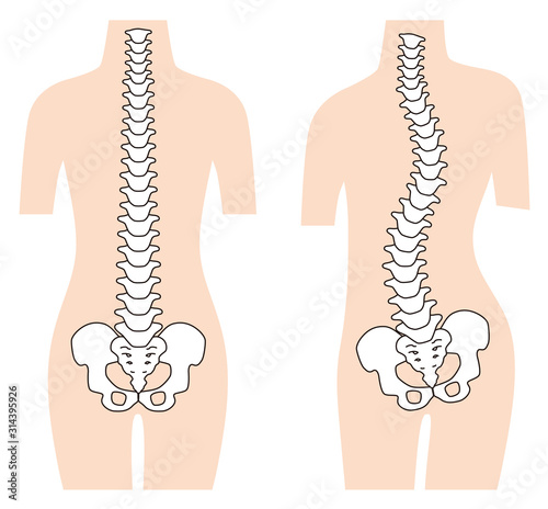 まっすぐな背骨 歪んだ背骨 脊椎側弯症