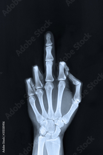 Hand sign x-ray of a flipped finger / middle finger sign.