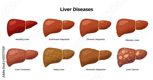 Healthy Liver and Liver diseases - fatty liver, hepatitis, fibrosis, cirrhosis, alcoholic hepatitis, liver cancer - medical infographic elements isolated on white background.