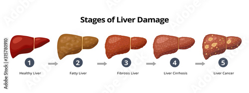Stages of liver damage from healthy, fatty liver, fibrosis, cirrhosis to liver cancer. Medical infographic, liver diseases icons in flat design isolated on white background.