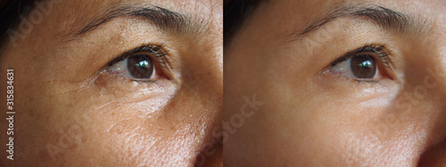 Image before and after treatment rejuvenation surgery on face asian woman concept.Closeup wrinkles dark spots pigmentation on senior female.