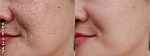 Image before and after spot melasma pigmentation facial treatment on face asian woman.Problem skincare and health concept.