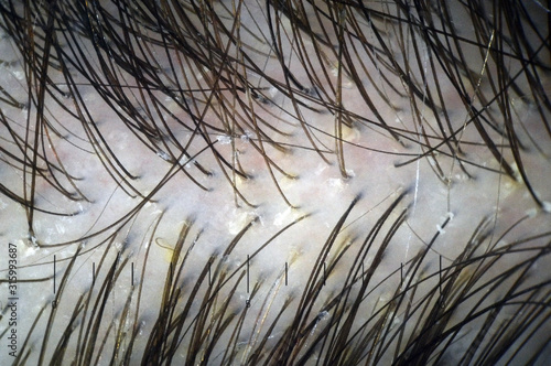 Scalp and hair with multiple exfoliation. Macroscopy of hair on the head with signs of peeling at hair follicles. Scalp dermoscopy. Hair treatment in the clinic.