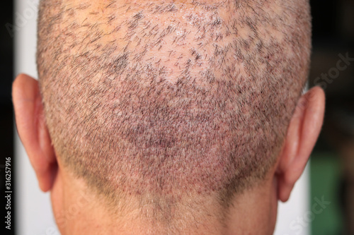 back view of a man's head with hair transplant surgery area