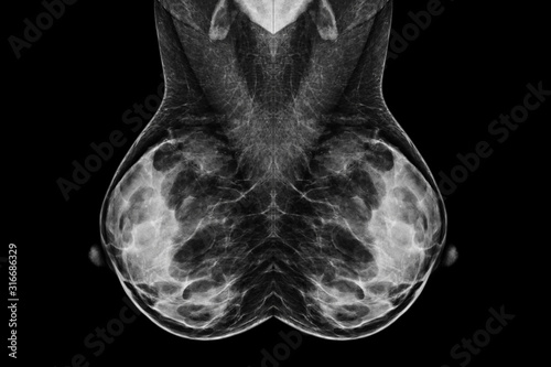 Digital Mammogram in MLO view.used in diagnosis, screening of breast cancer.