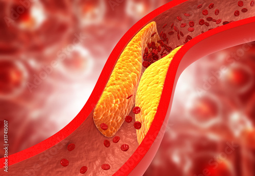 Clogged arteries, Cholesterol plaque in artery. 3d illustration