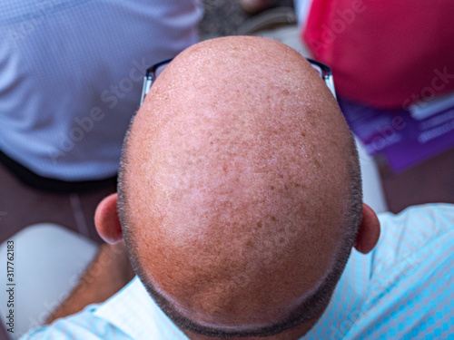 baldness therapy from man head