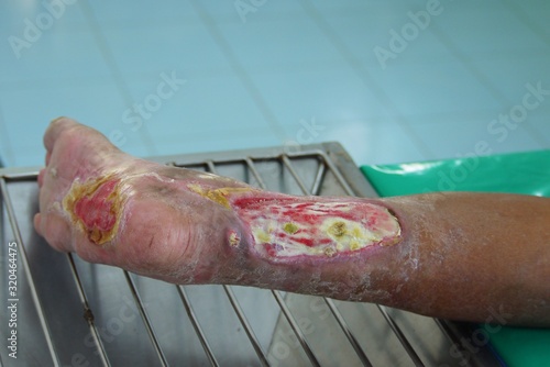 Selective focus diabetic foot ulcer on leg .